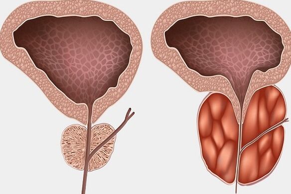 Inflamacion i prostatës