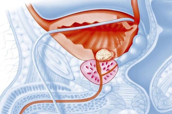 Proces inflamator në prostatë