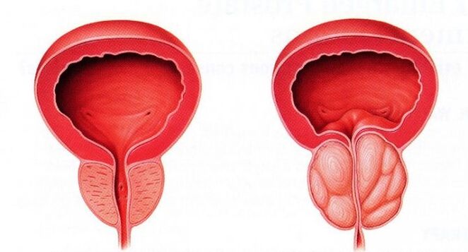 prostatë e shëndetshme dhe e përflakur me prostatit kronik