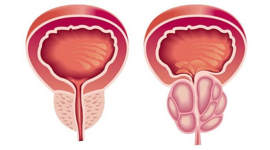 Prostatë e shëndetshme dhe e përflakur me prostatit
